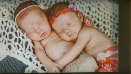 Find-out-why-these-twin-girls-became-famous-on-the-day-of-their-birth-1